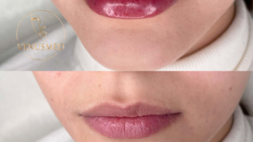 aumento de labios con VenusMed