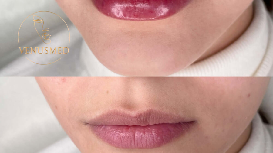 aumento de labios con VenusMed