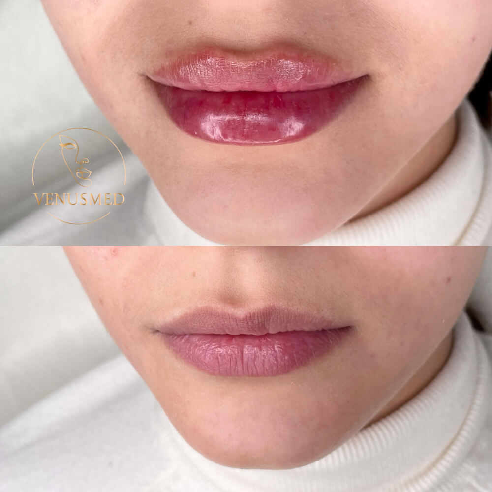 aumento de labios con VenusMed