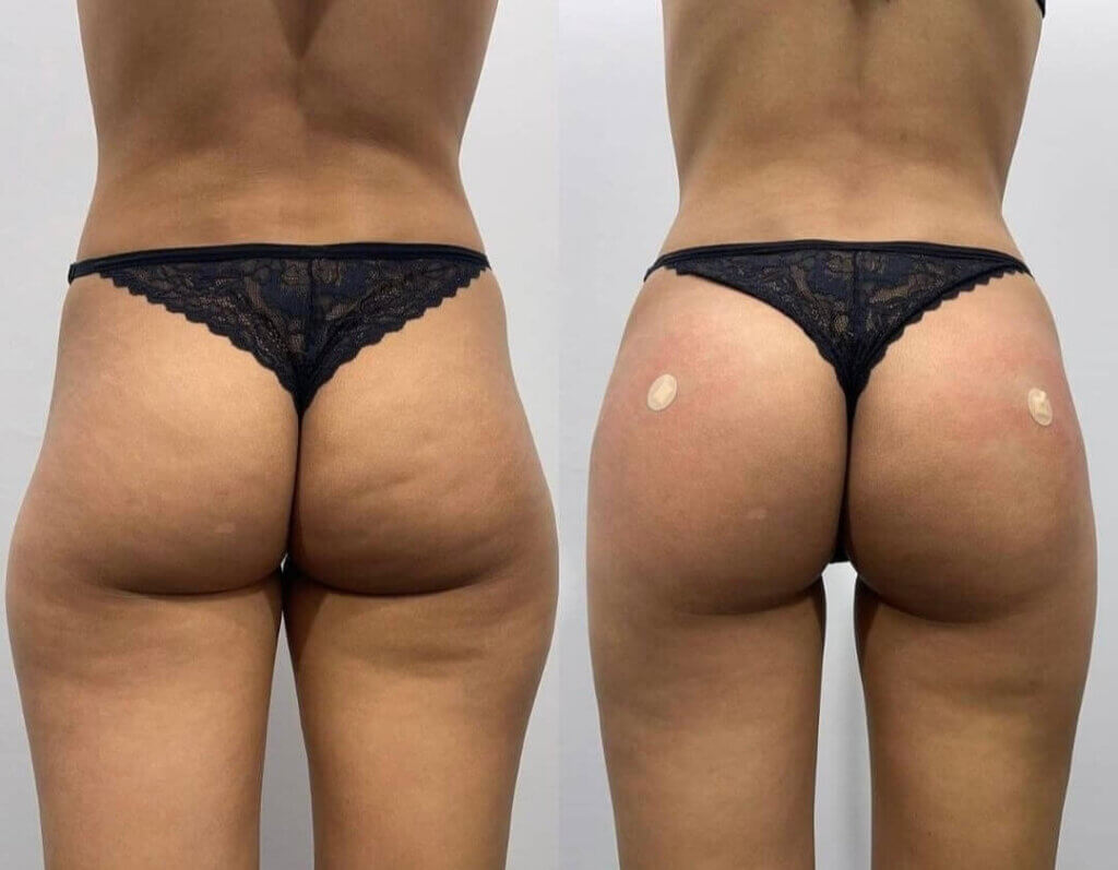 Aumento de glúteos con Ácido Hialurónico